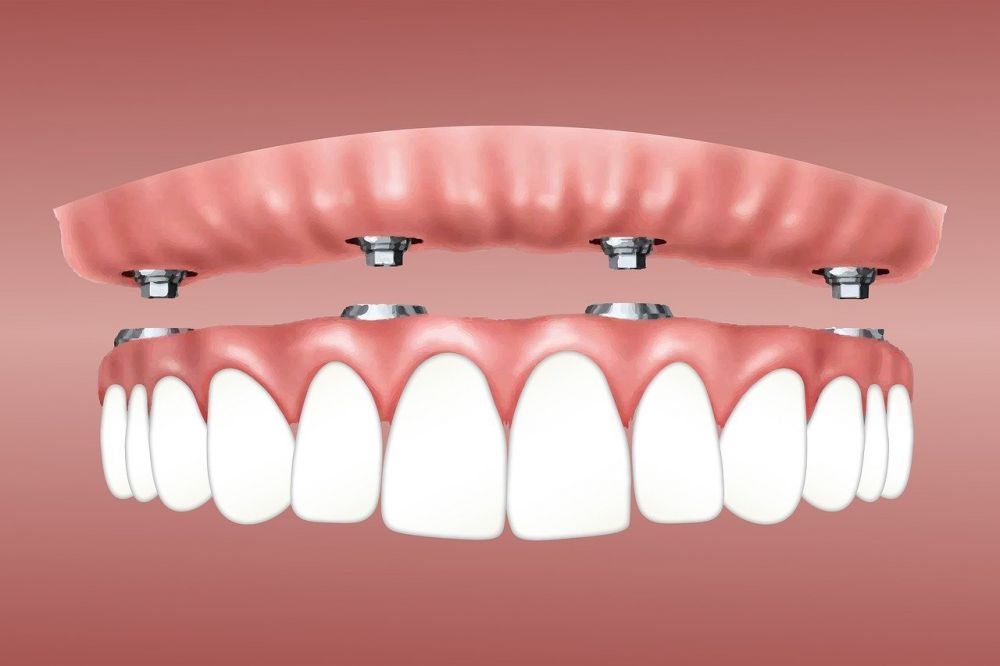 dental implants malmö