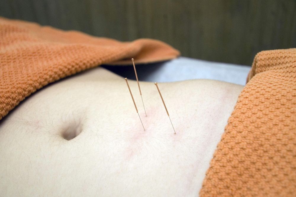 acupuncture Stockholm