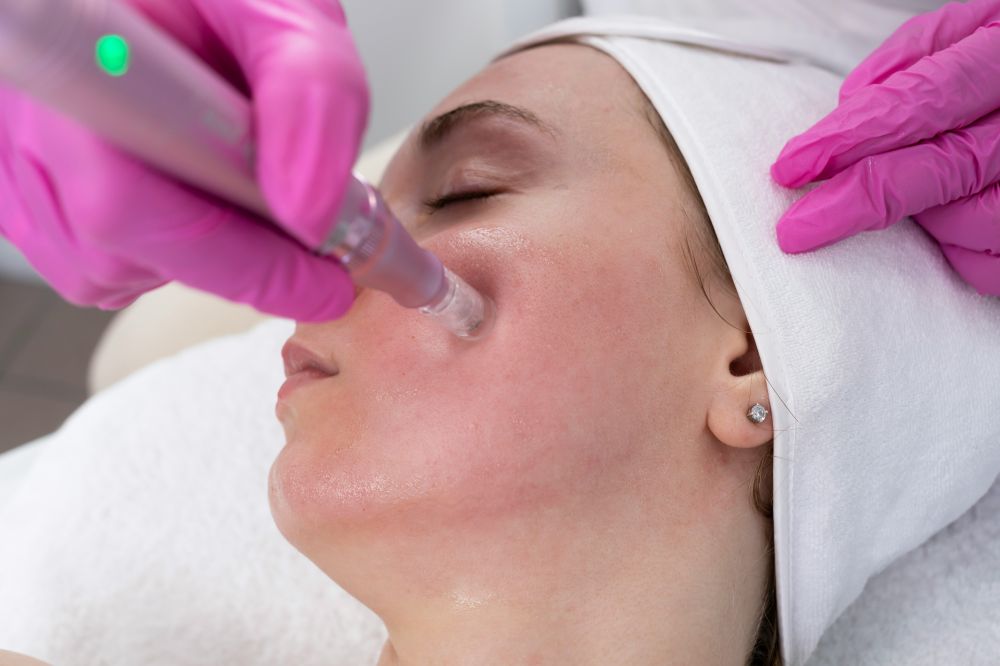 microneedling mountains