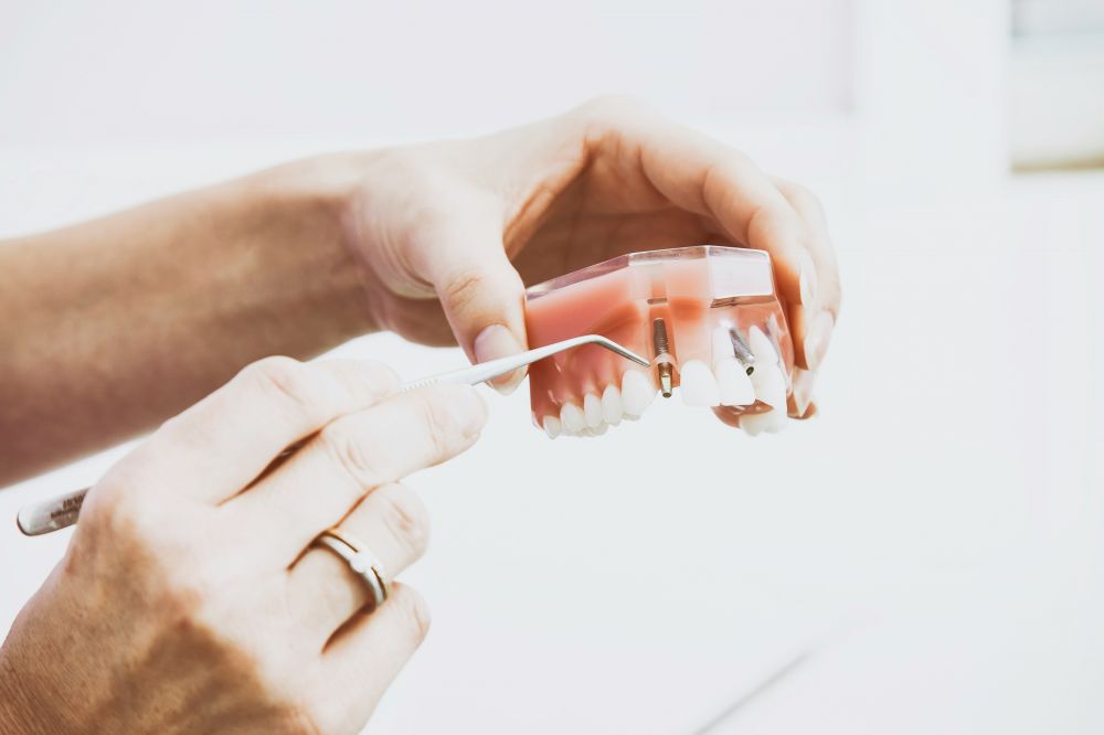 Tandimplantat – pris för en tand som ser ut som din egen