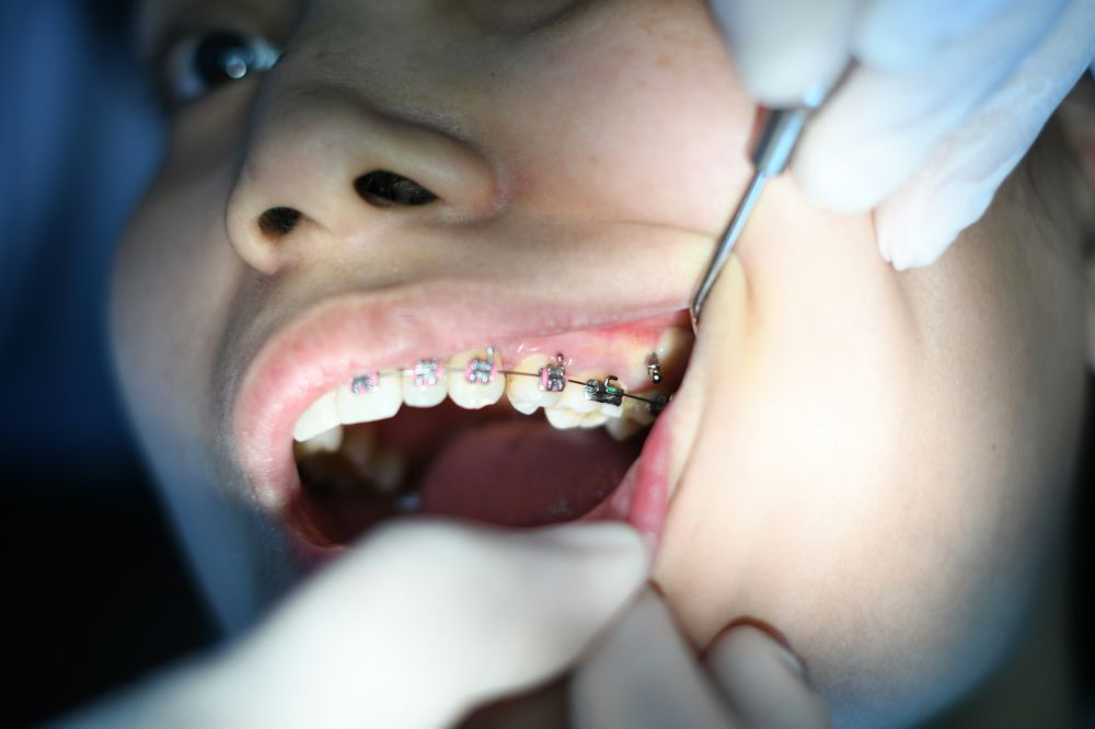 usynlig tannregulering