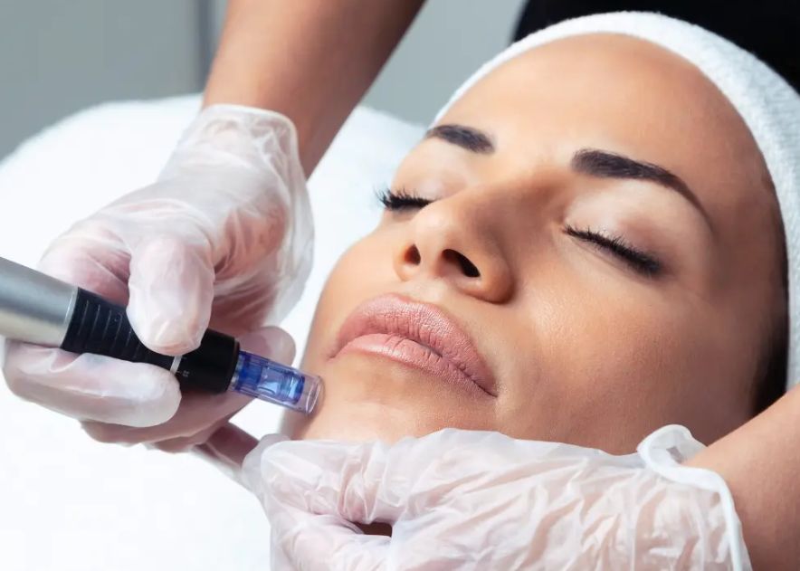 microneedling stockholm