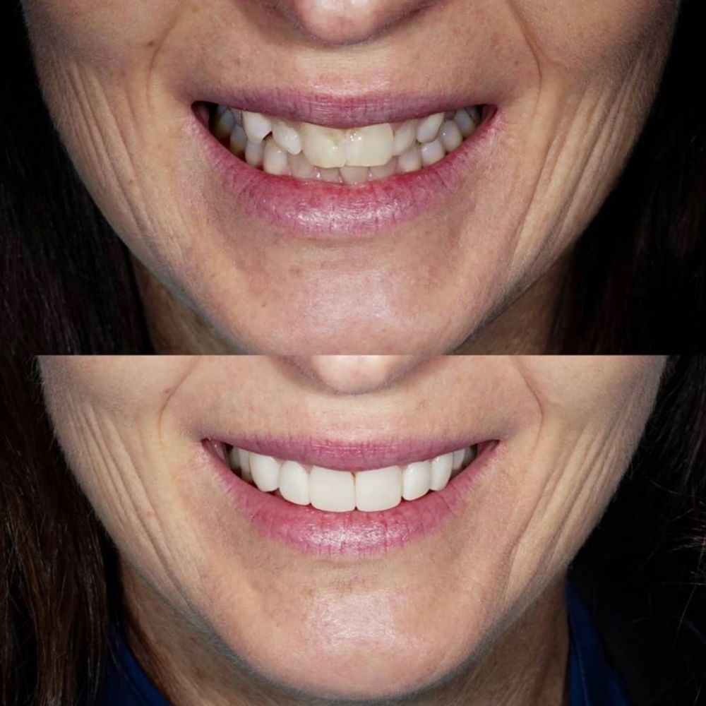 Dental implants - never be ashamed of your smile again!